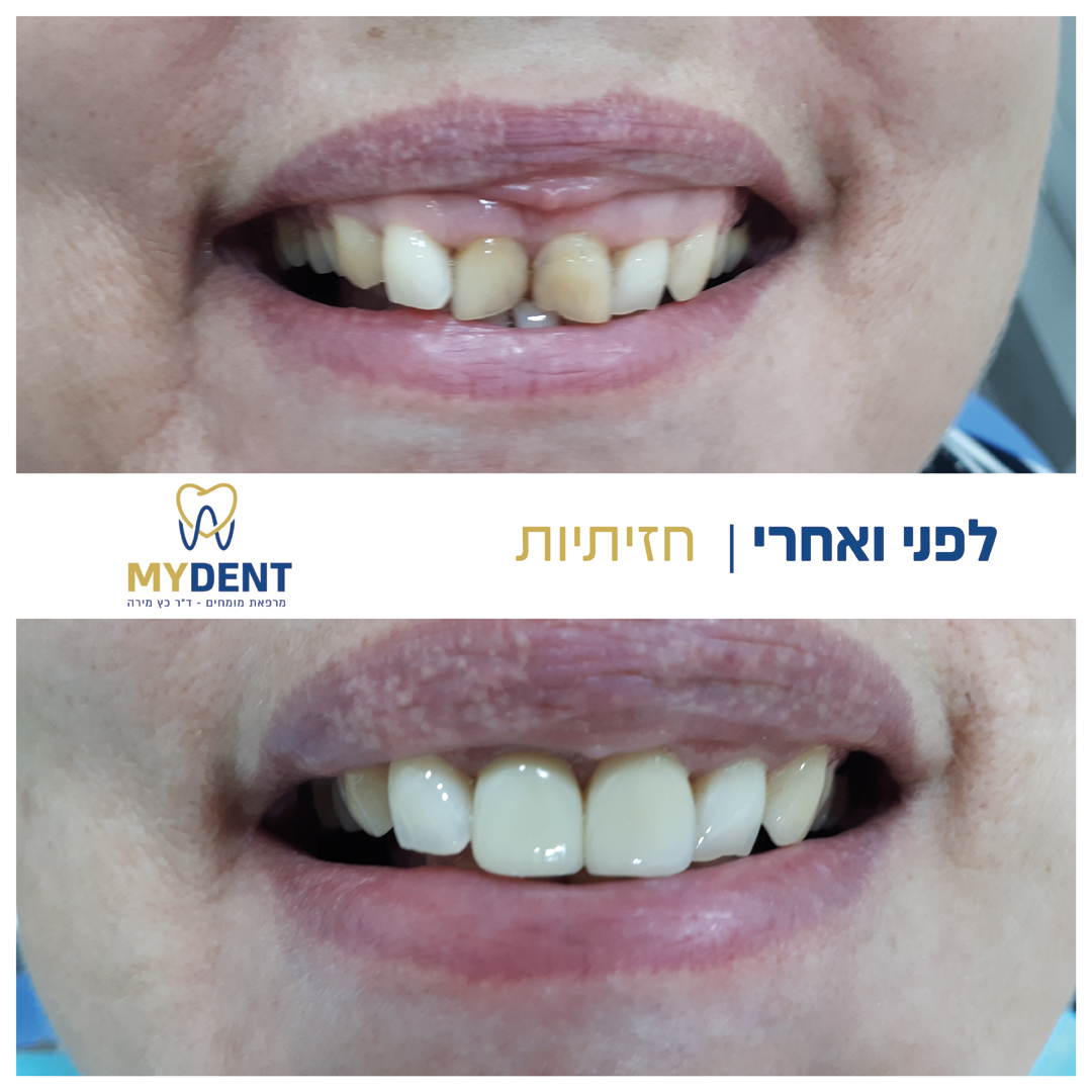 פוסט_לפני_ואחרי_חזיתיות