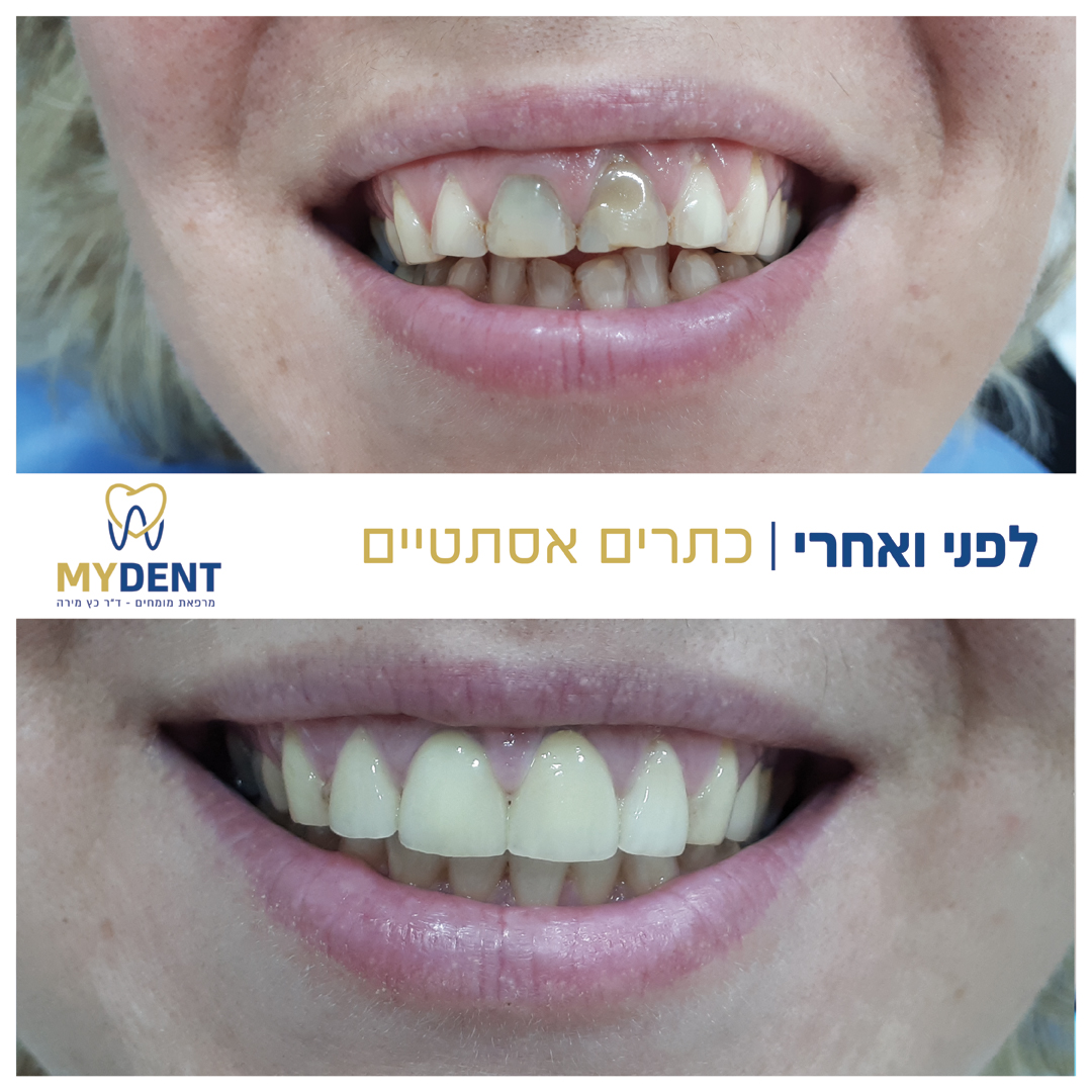 כתרים אסתטיים-1