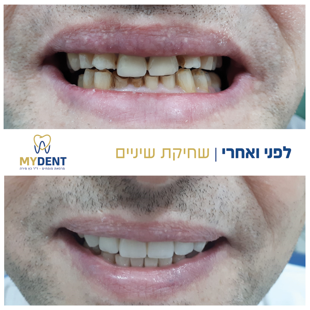 שחיקת שיניים