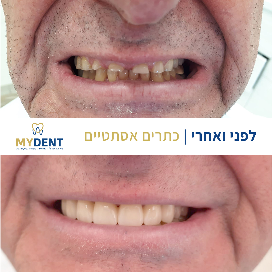 before - after 1