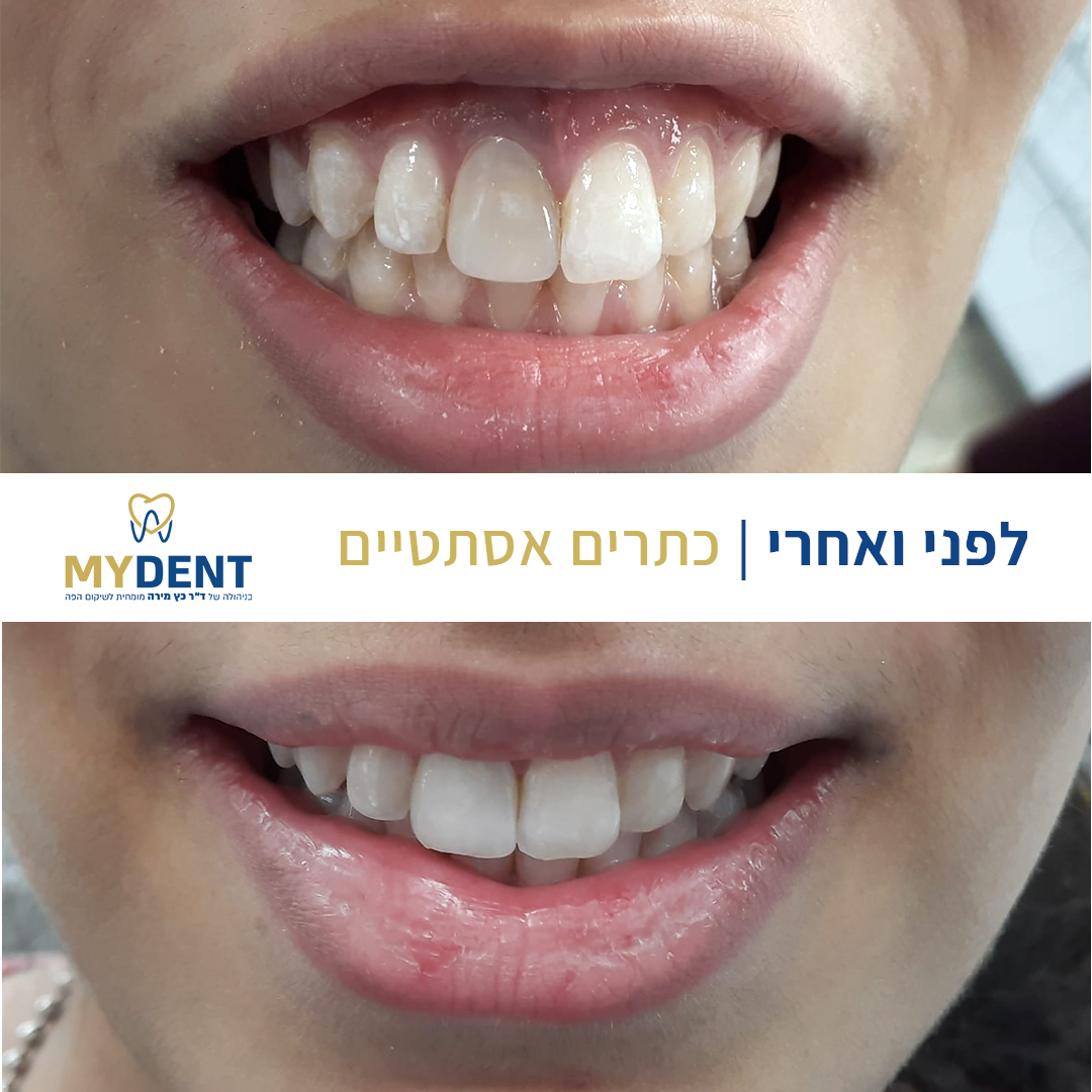 before - after 2